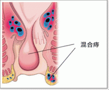什么是混合痔